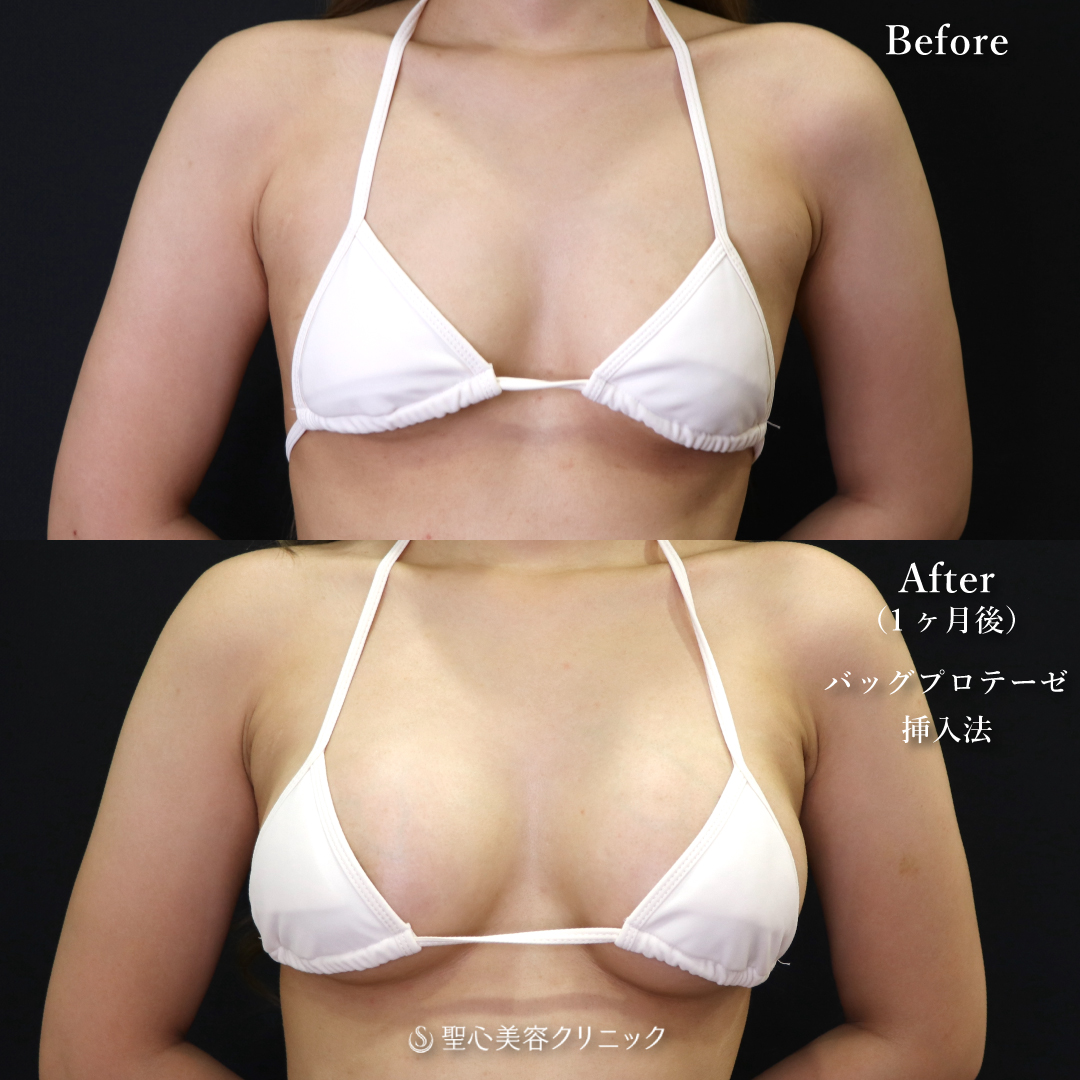 【20代女性・お胸をしっかり大きくしたい】モティバエルゴノミクス250cc（1ヶ月後） Before 
