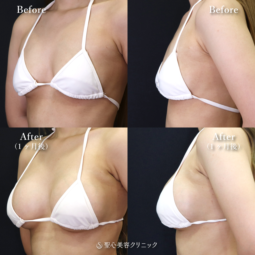 【20代女性・お胸をしっかり大きくしたい】モティバエルゴノミクス250cc（1ヶ月後） After 