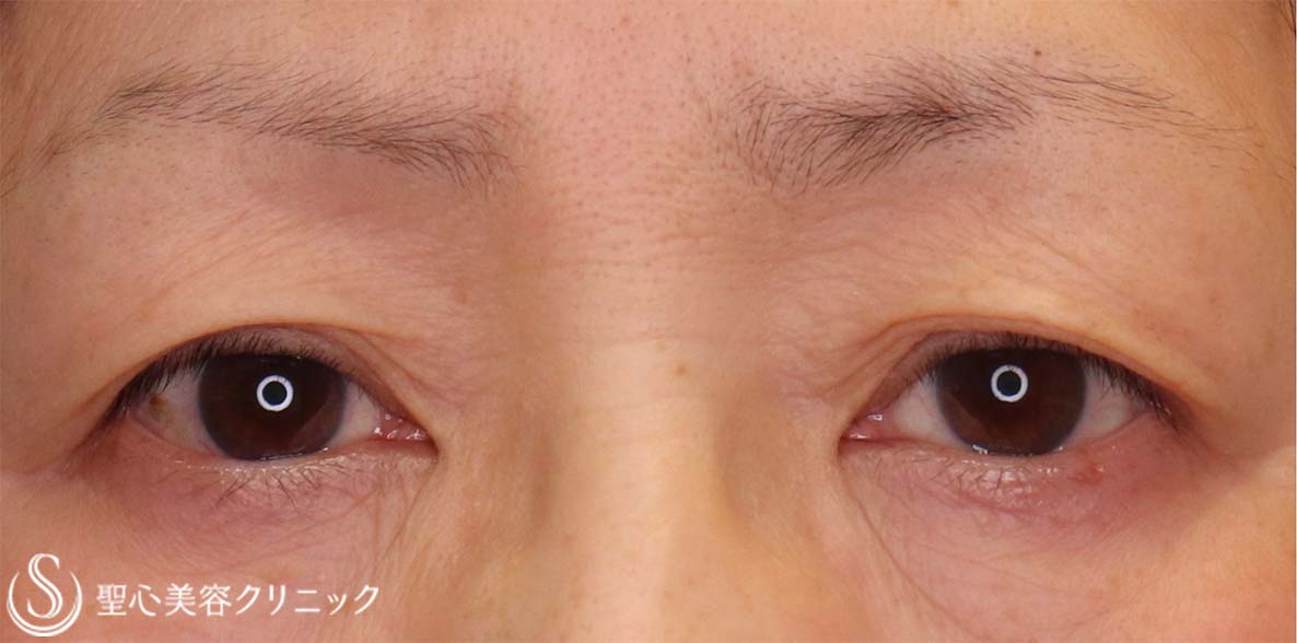 【60代女性・目の上をナチュラルにスッキリ！！】眉下リフト（眉下切開法）（術後5ヶ月） Before 