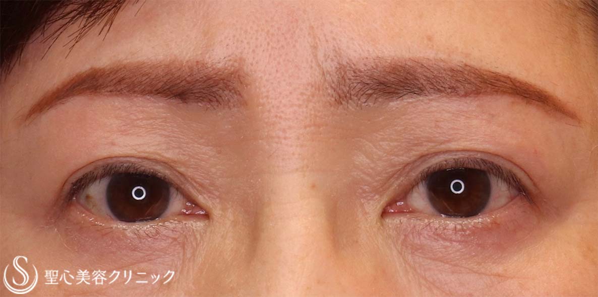 【60代女性・目の上をナチュラルにスッキリ！！】眉下リフト（眉下切開法）（術後5ヶ月） After 