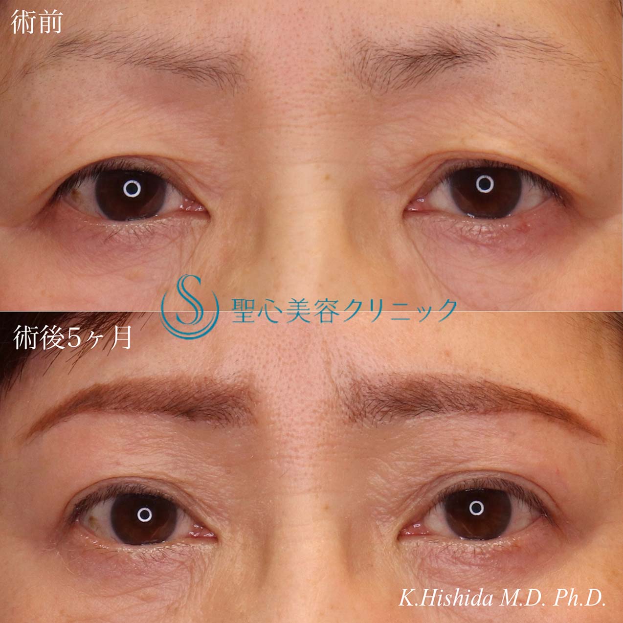 【60代女性・目の上をナチュラルにスッキリ！！】眉下リフト（眉下切開法）（術後5ヶ月） After 