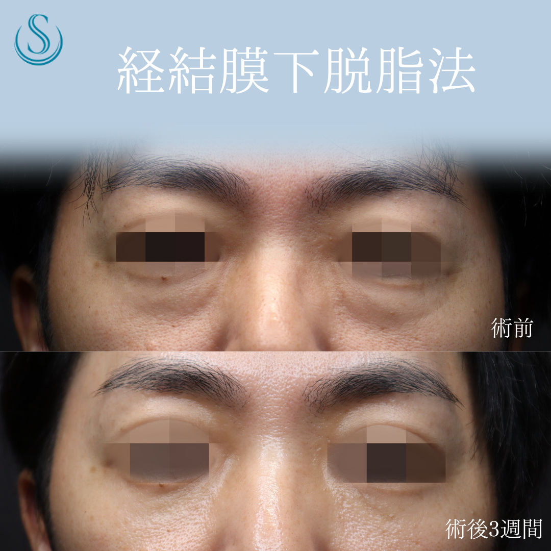 【40代男性・切らない目の下のクマ取りでスッキリ】目の下の脂肪取り（経結膜下脱脂法）（術後3週間） Before 