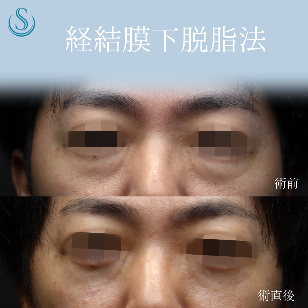 【40代男性・切らない目の下のクマ取りでスッキリ】目の下の脂肪取り（経結膜下脱脂法）（術後3週間） Before 