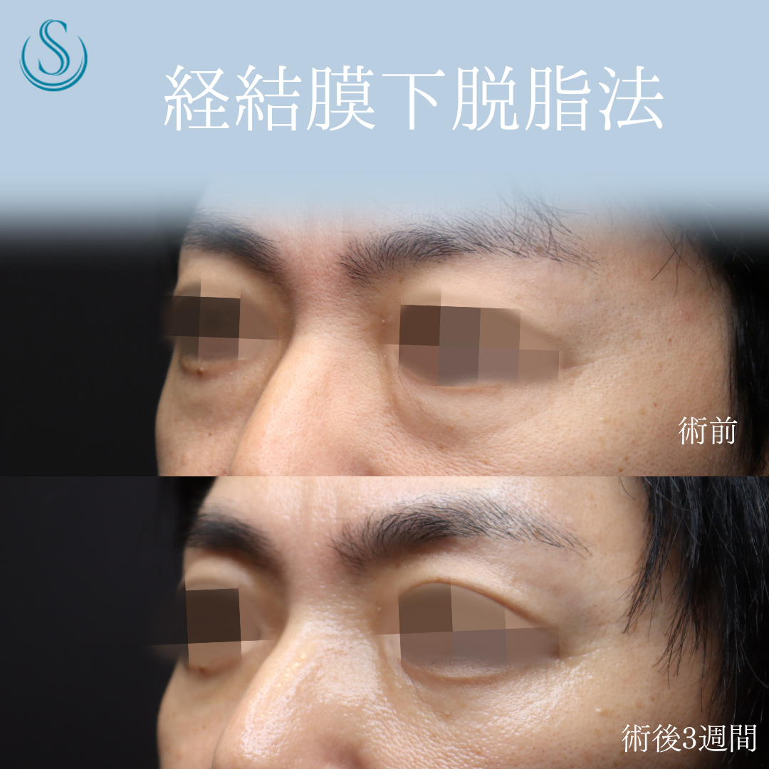 【40代男性・切らない目の下のクマ取りでスッキリ】目の下の脂肪取り（経結膜下脱脂法）（術後3週間） After 