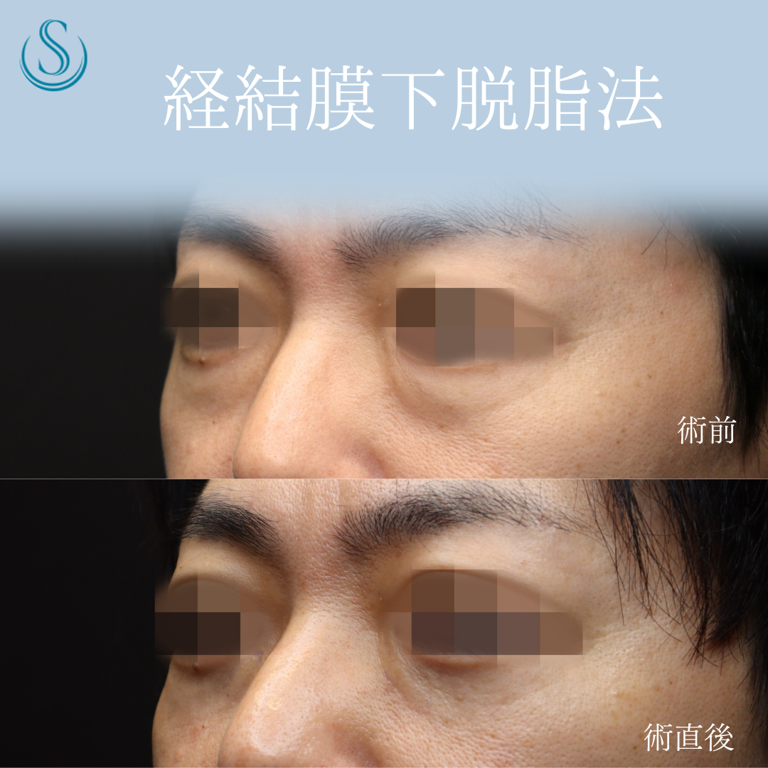 【40代男性・切らない目の下のクマ取りでスッキリ】目の下の脂肪取り（経結膜下脱脂法）（術後3週間） After 