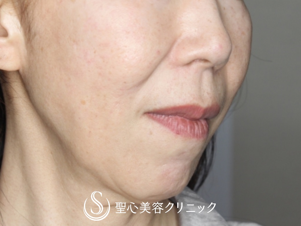 【50代女性・鼻の下を短く】リップリフト（3ヶ月後） Before 