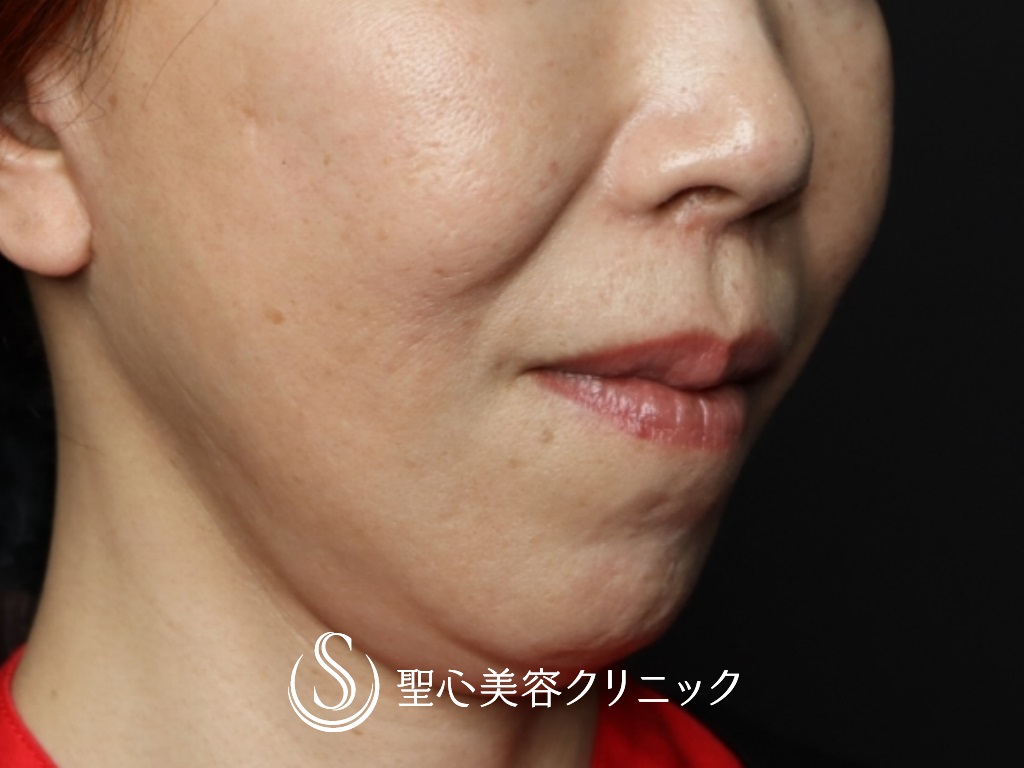 【50代女性・鼻の下を短く】リップリフト（3ヶ月後） After 
