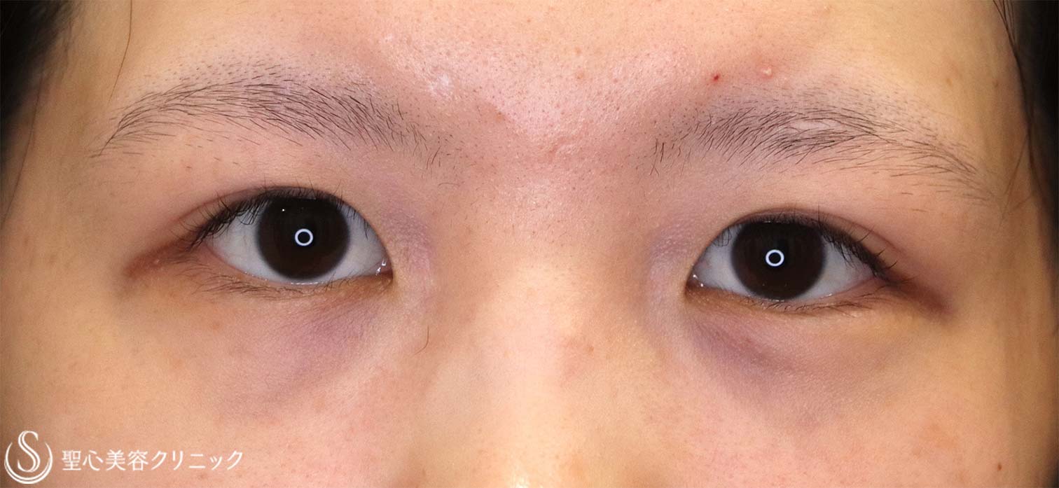 【20代女性・目元を大きく見せる】目頭切開（1週間後） Before 