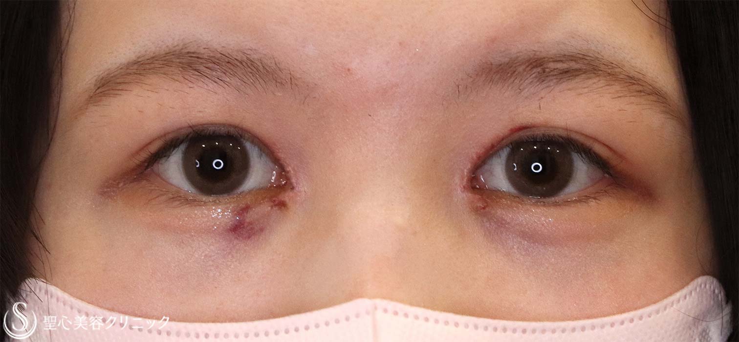 【20代女性・目元を大きく見せる】目頭切開（1週間後） After 