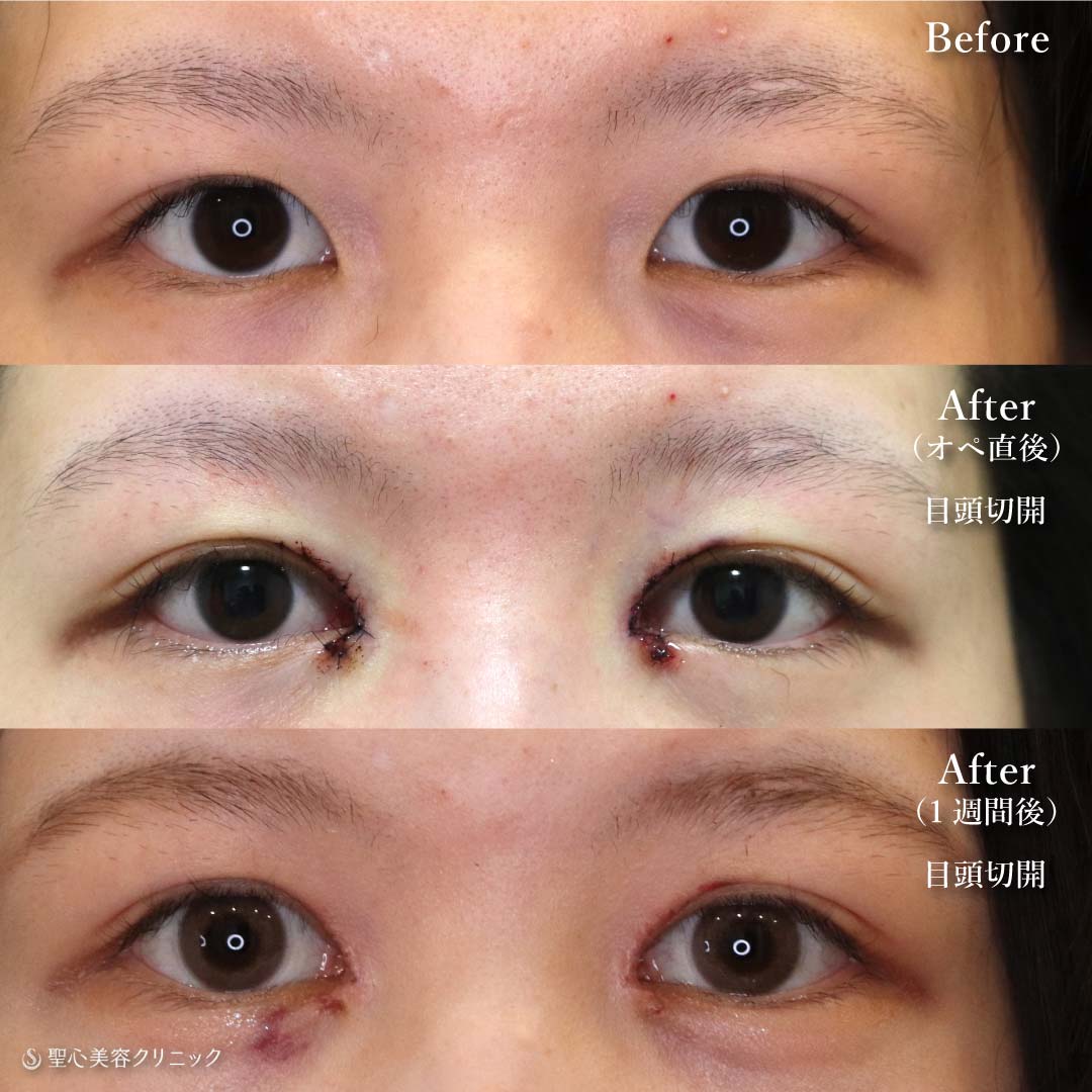 【20代女性・目元を大きく見せる】目頭切開（1週間後） After 