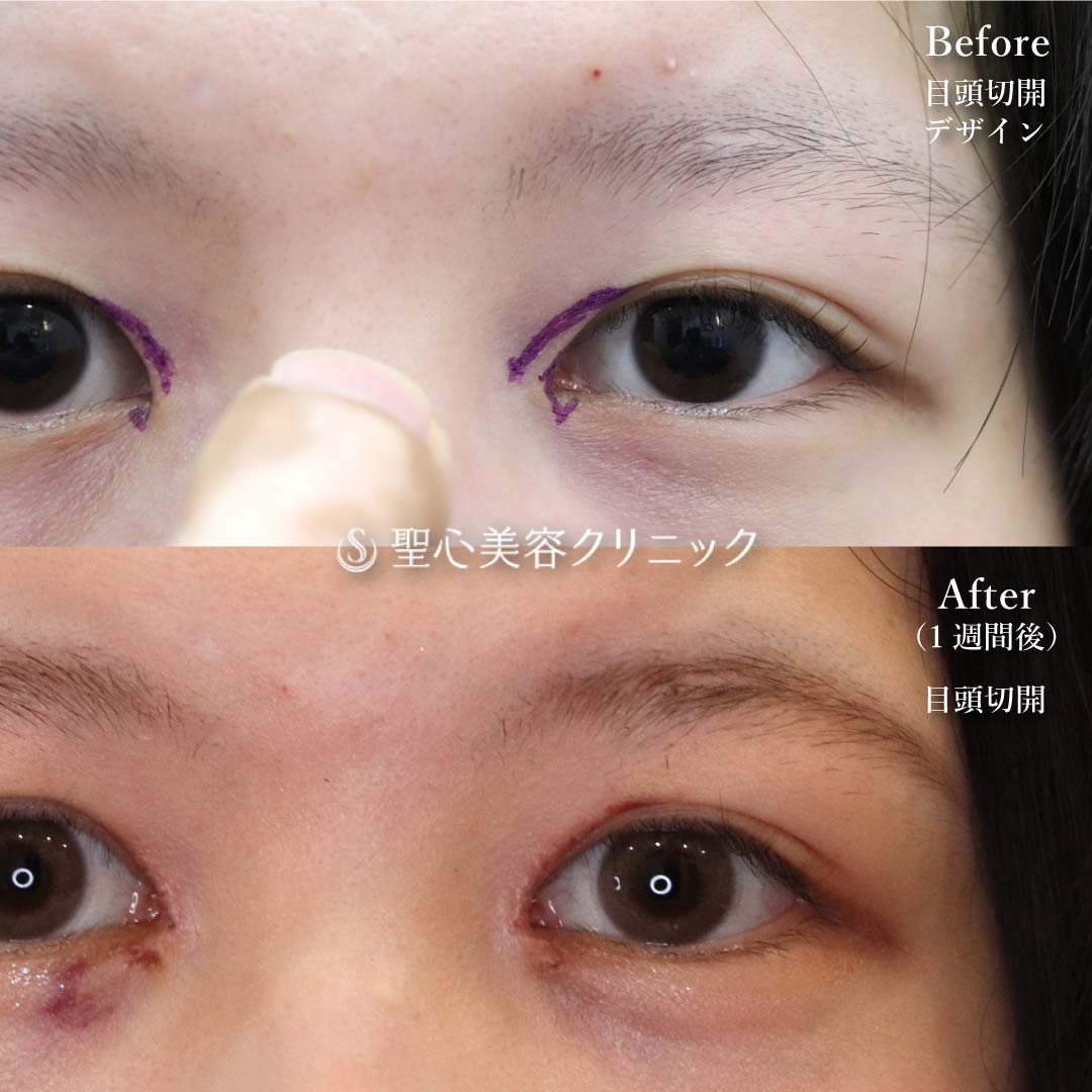 【20代女性・目元を大きく見せる】目頭切開（1週間後） After 