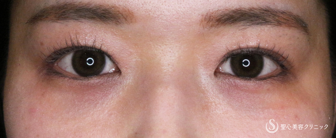 【20代女性・自然で上品な涙袋をつくる】ヒアルロン酸注入（処置直後〜1ヶ月後） Before 