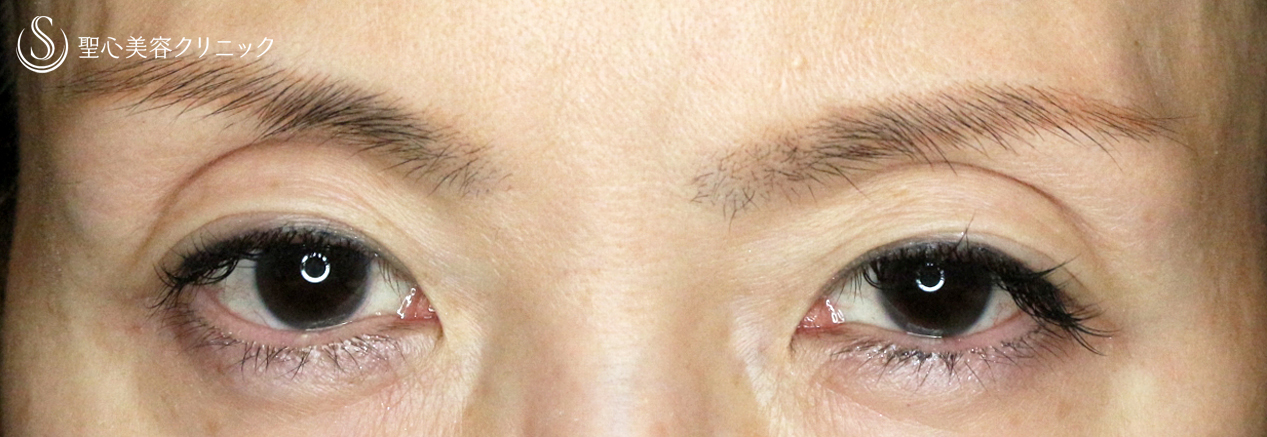 【50代女性・他院切開法後の修正例】切らない眼瞼下垂+α法単独（3年後） Before 