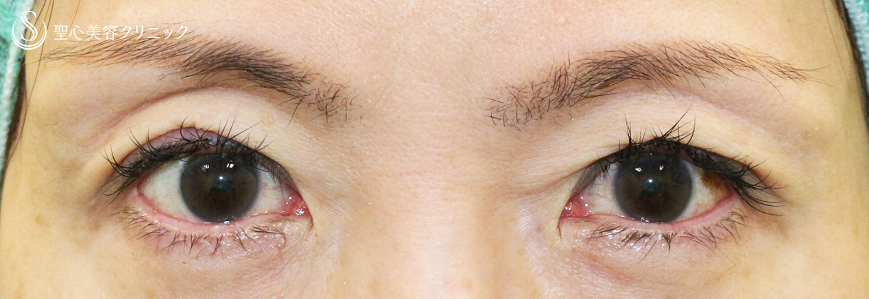 【50代女性・他院切開法後の修正例】切らない眼瞼下垂+α法単独（3年後） Before 