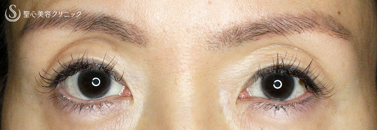 【50代女性・他院切開法後の修正例】切らない眼瞼下垂+α法単独（3年後） After 