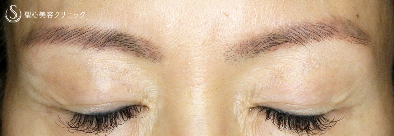 【50代女性・他院切開法後の修正例】切らない眼瞼下垂+α法単独（3年後） After 