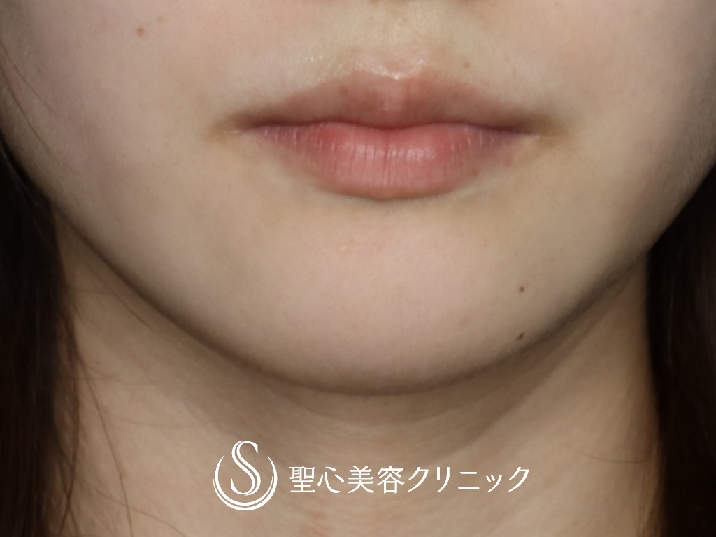 【20代女性・口角を挙げて印象を良くしたい】プレミアム口角挙上術（1か月後） Before 