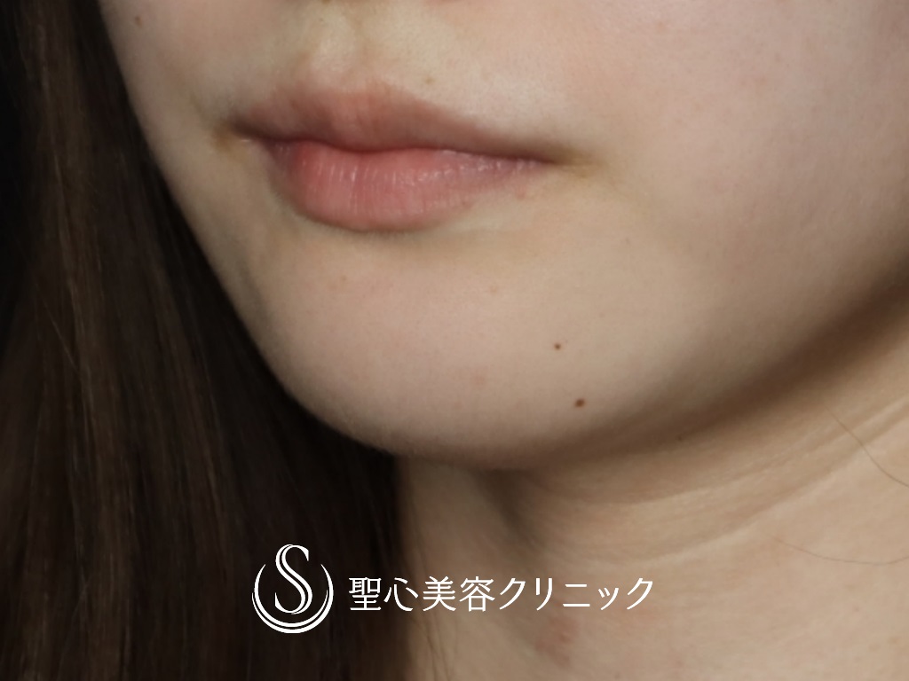 【20代女性・口角を挙げて印象を良くしたい】プレミアム口角挙上術（1か月後） Before 