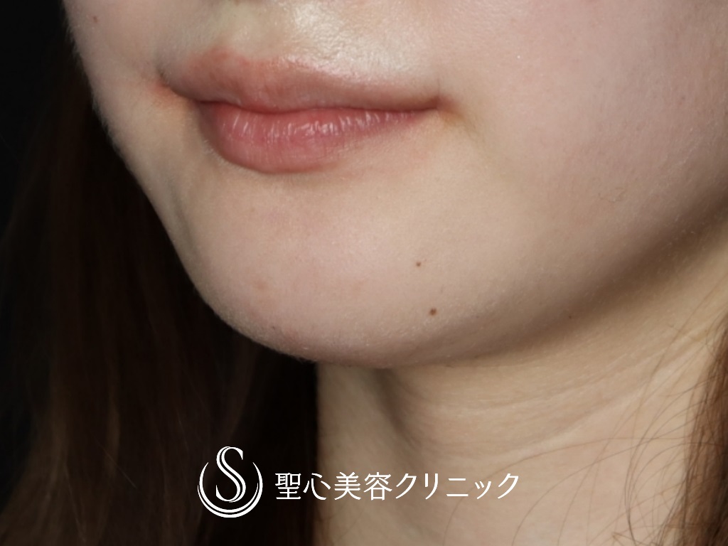 【20代女性・口角を挙げて印象を良くしたい】プレミアム口角挙上術（1か月後） After 
