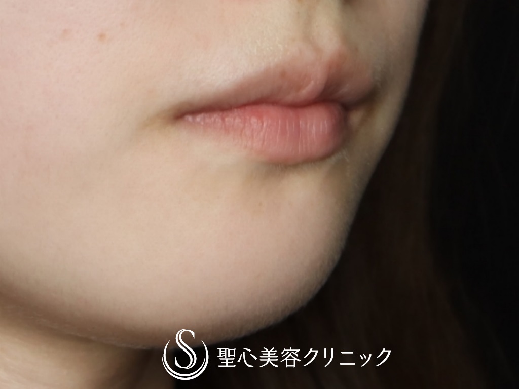 【20代女性・口角を挙げて印象を良くしたい】プレミアム口角挙上術（1か月後） Before 