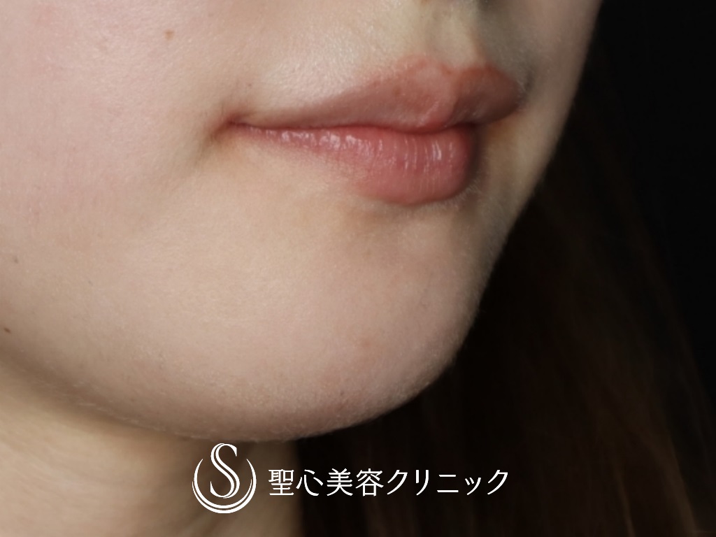 【20代女性・口角を挙げて印象を良くしたい】プレミアム口角挙上術（1か月後） After 