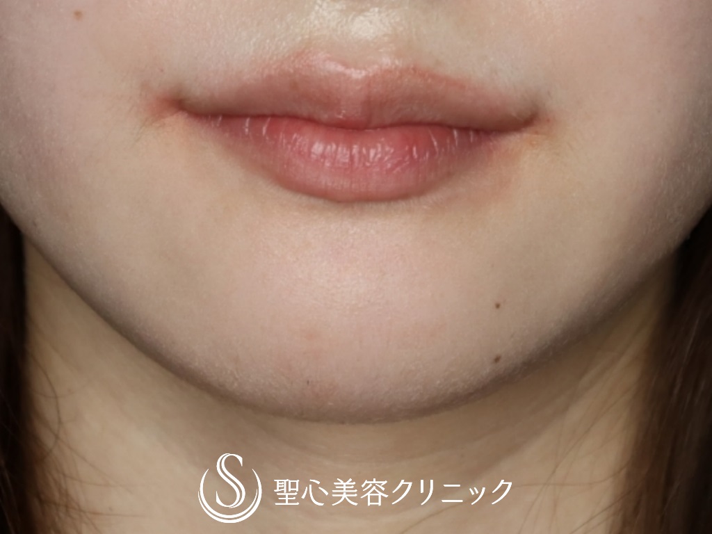 【20代女性・口角を挙げて印象を良くしたい】プレミアム口角挙上術（1か月後） After 
