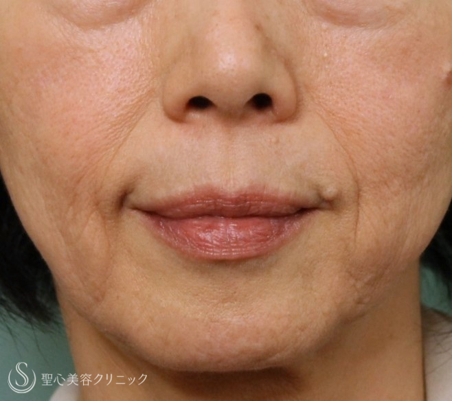 【70代女性・ほうれい線】プレミアムPRP皮膚再生療法（7年後） Before 