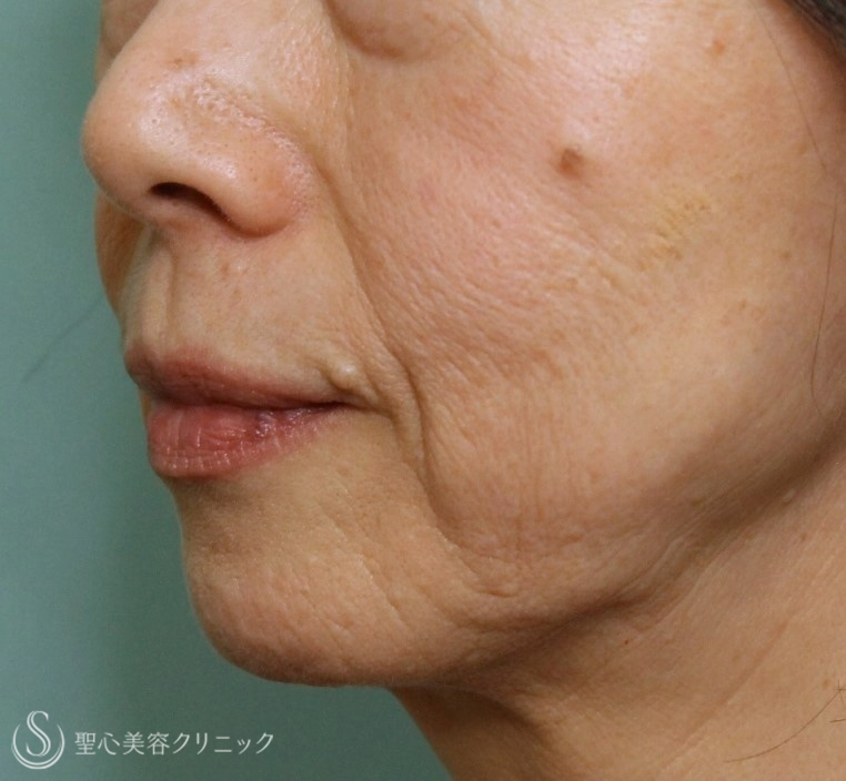 【70代女性・ほうれい線】プレミアムPRP皮膚再生療法（7年後） Before 