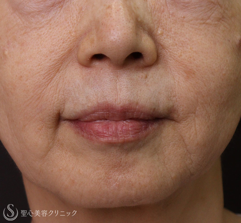 【70代女性・ほうれい線】プレミアムPRP皮膚再生療法（7年後） After 