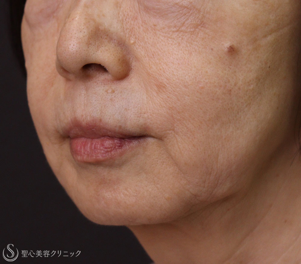 【70代女性・ほうれい線】プレミアムPRP皮膚再生療法（7年後） After 