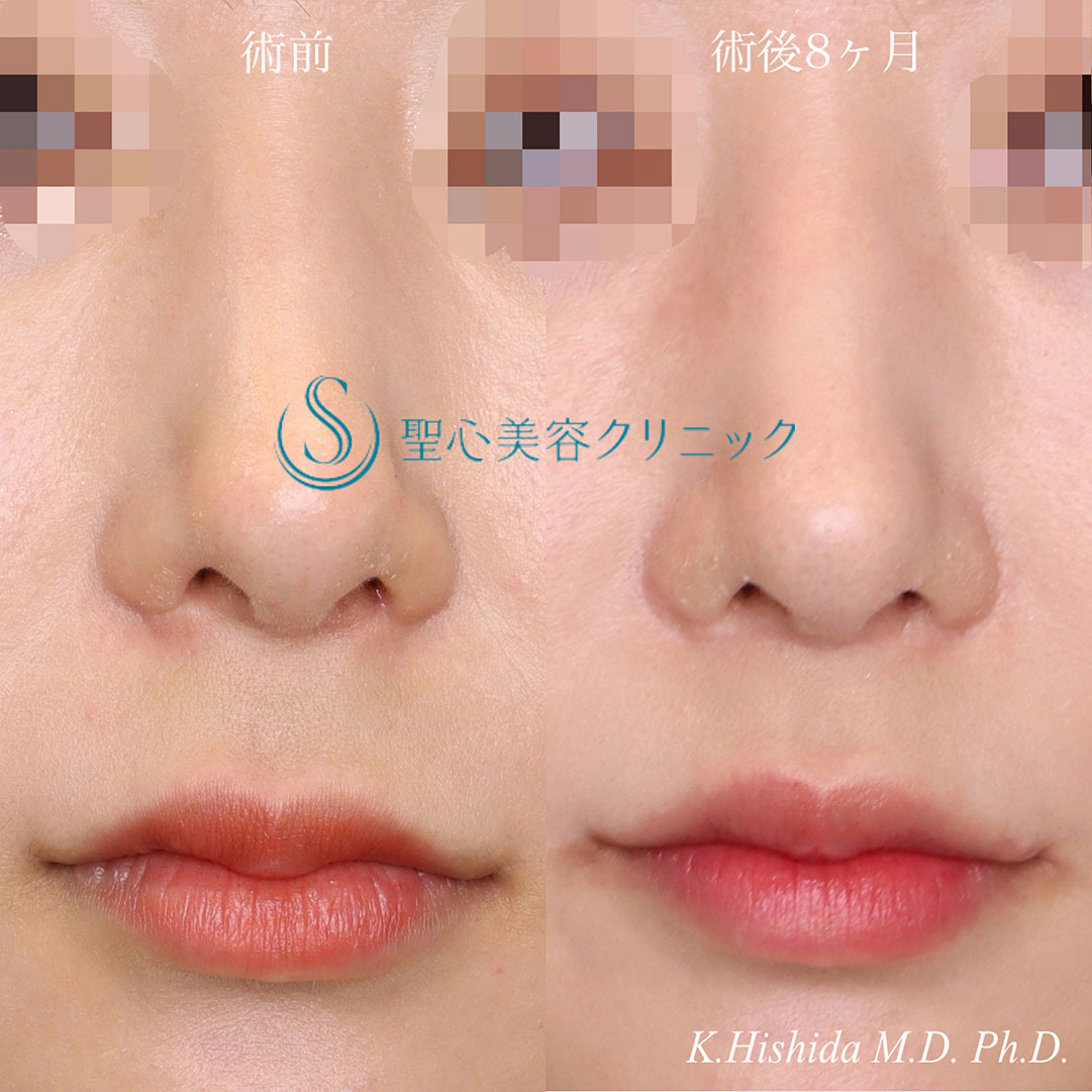 【20代女性・人中をバランスよく短くしたい！！】プレミアムリップリフト（プレミアム人中短縮術）＋外側人中短縮術（口角挙上術）（術後8ヶ月） After 
