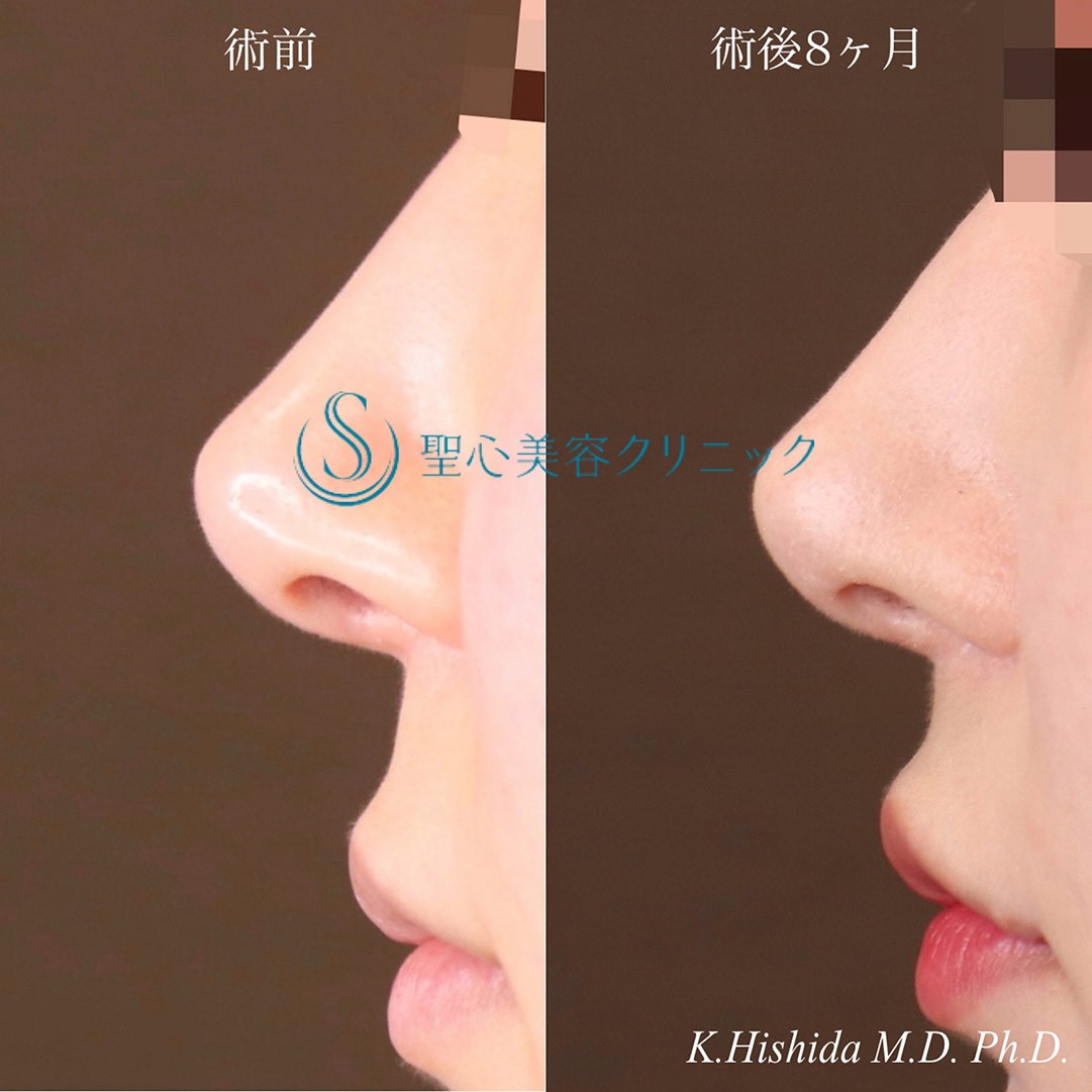 【20代女性・人中をバランスよく短くしたい！！】プレミアムリップリフト（プレミアム人中短縮術）＋外側人中短縮術（口角挙上術）（術後8ヶ月） After 