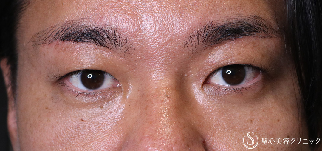 【30代男性・目の上のたるみ・左右差】眉下切開法（6ヶ月後） After 