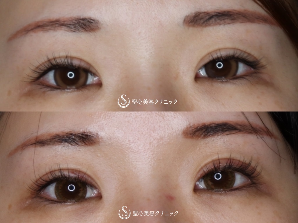 【20代女性・ハム目解消】睫毛上皮膚切除 After 