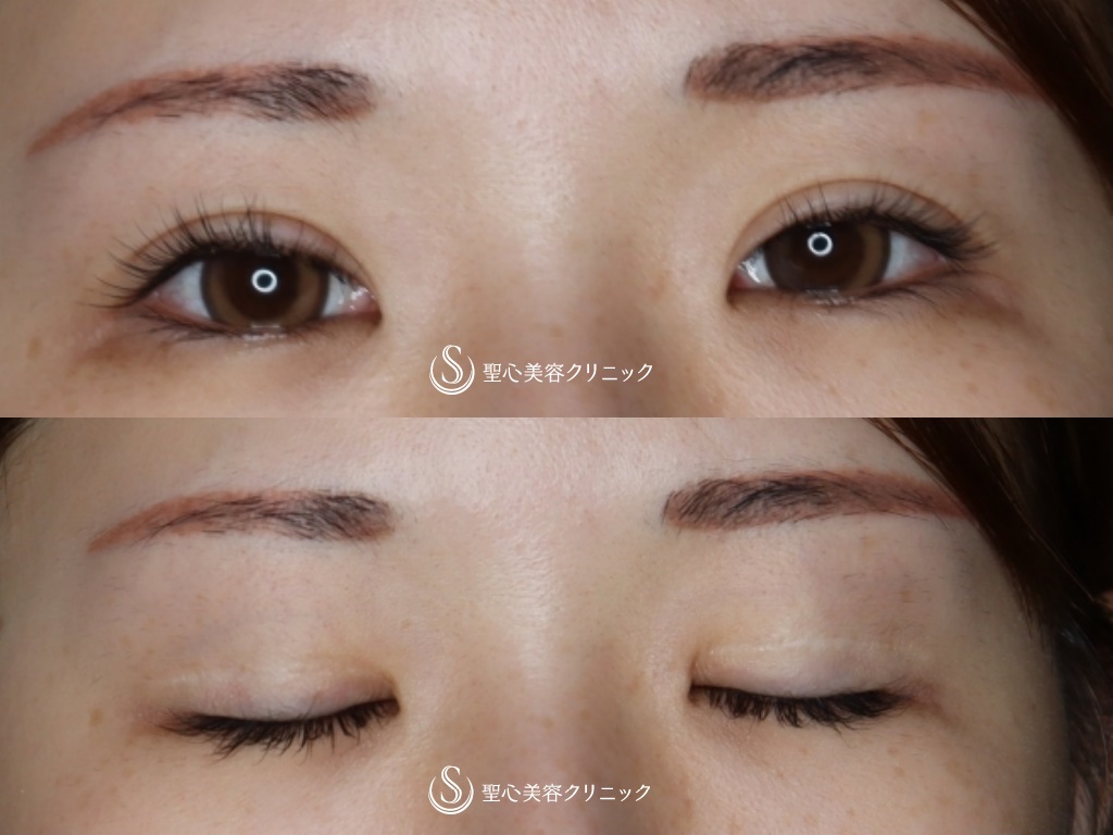 【20代女性・ハム目解消】睫毛上皮膚切除 Before 