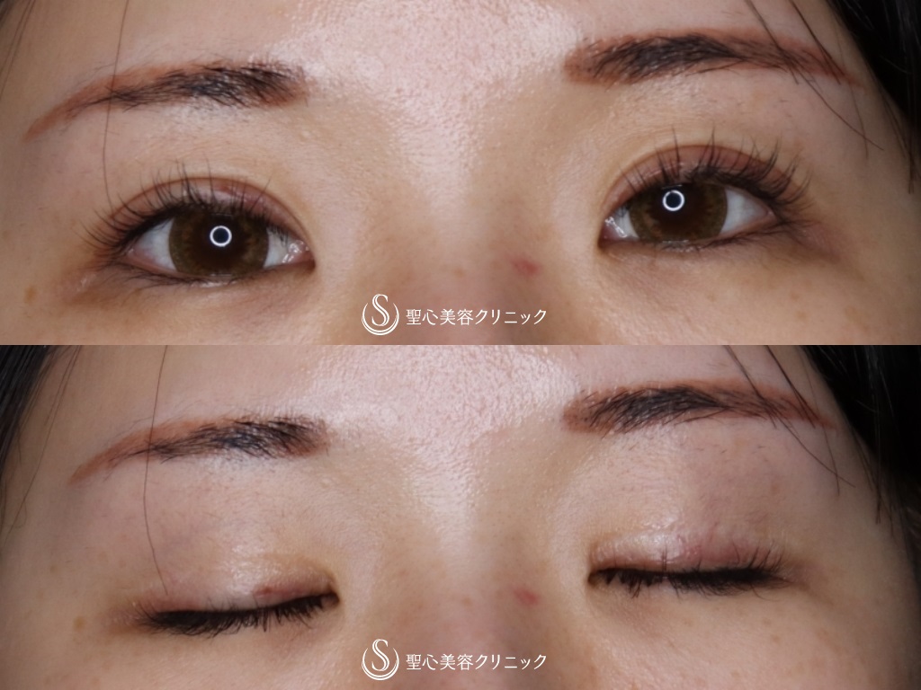 【20代女性・ハム目解消】睫毛上皮膚切除 After 
