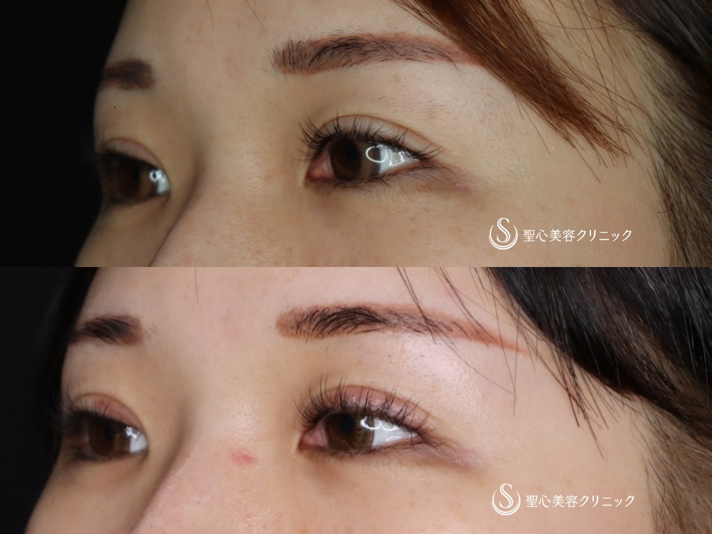 【20代女性・ハム目解消】睫毛上皮膚切除 After 
