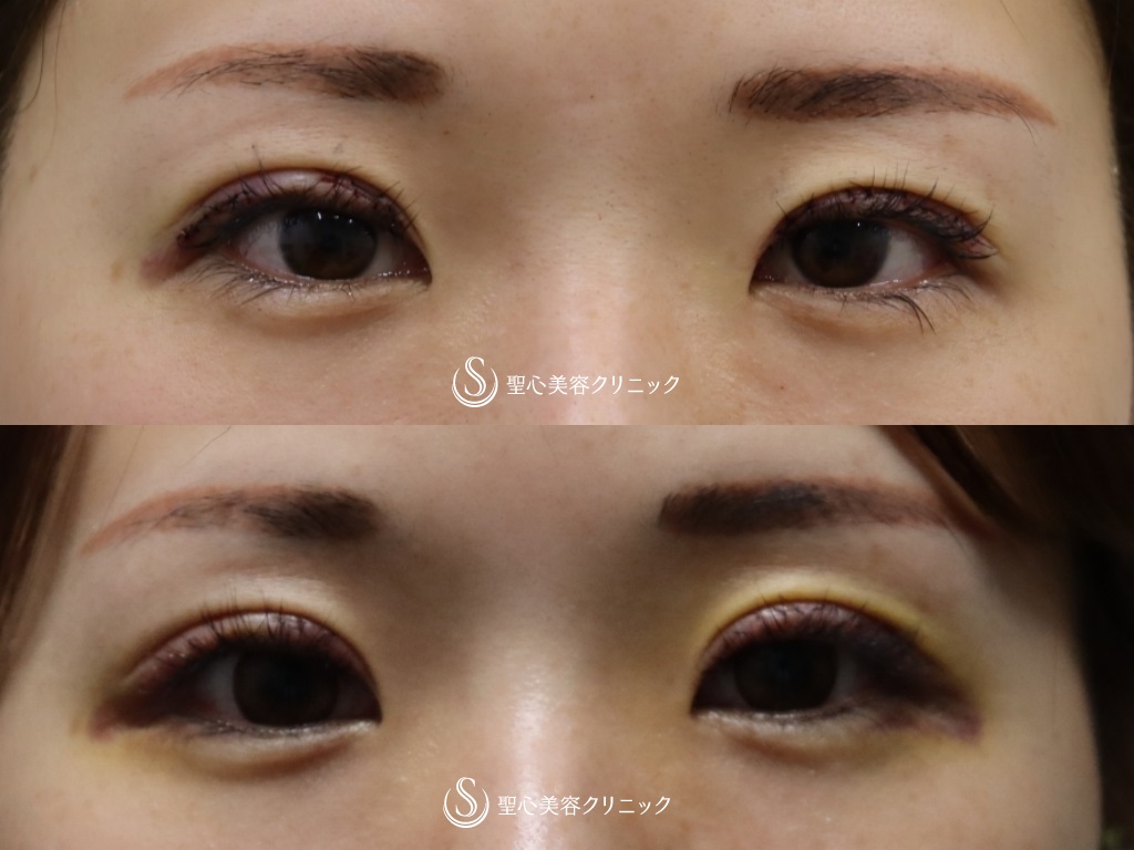 【20代女性・ハム目解消】睫毛上皮膚切除 After 