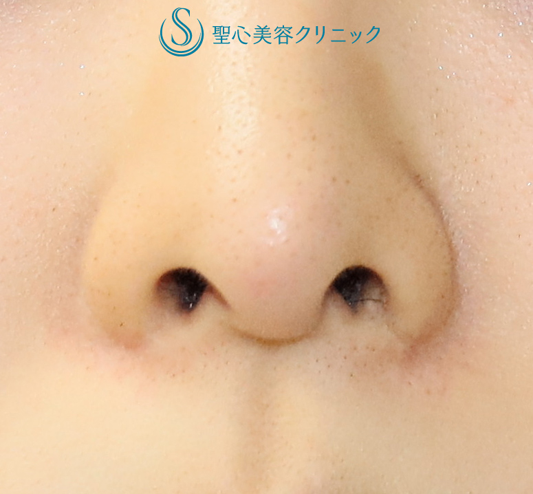 【20代女性・正面から見て鼻の穴を見えにくくする】鼻孔縁下降術（1ヶ月後） Before 