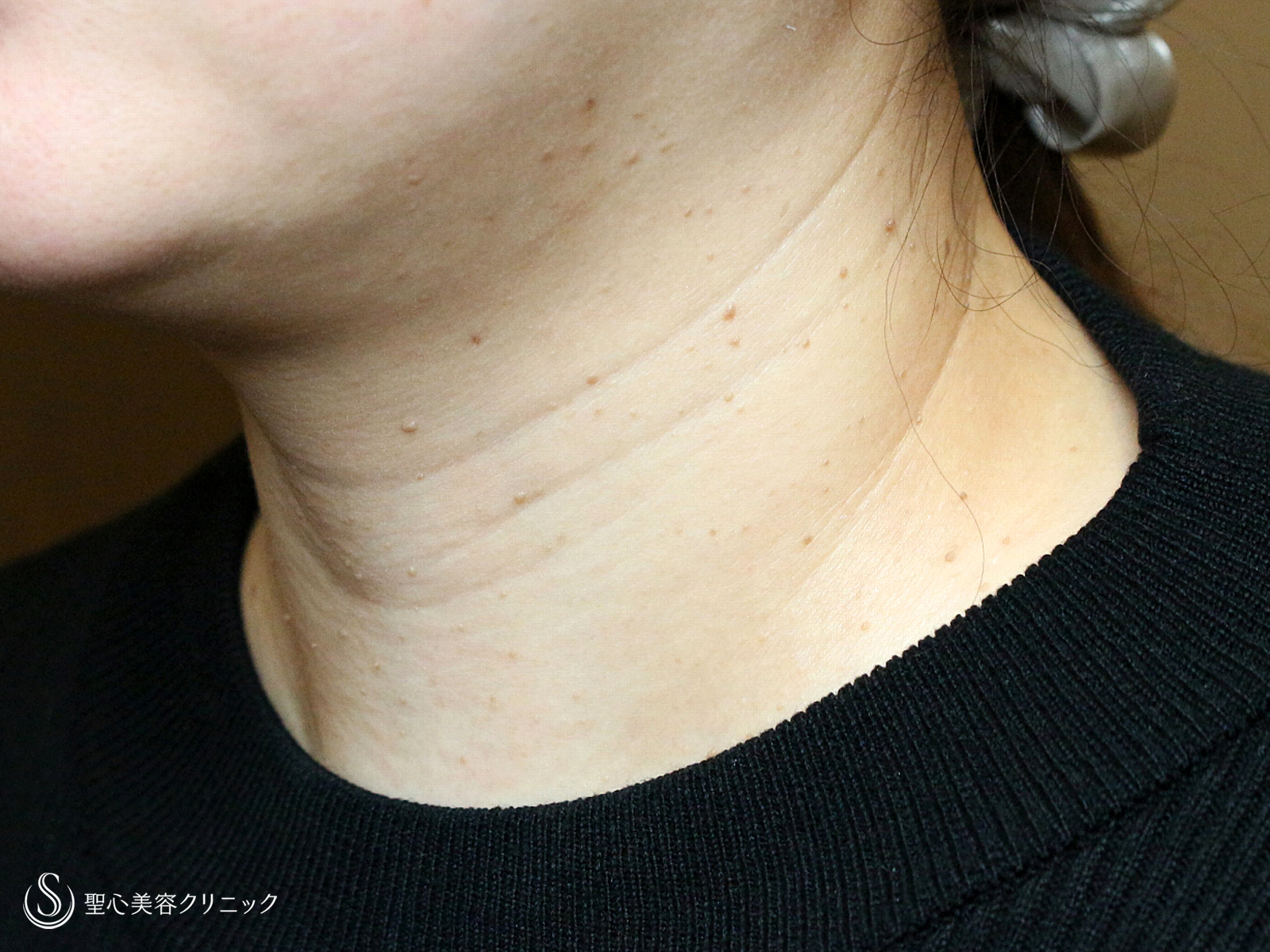 【40代女性・首の横ジワを綺麗にする】プレミアムPRP皮膚再生療法（9ヶ月後） Before 