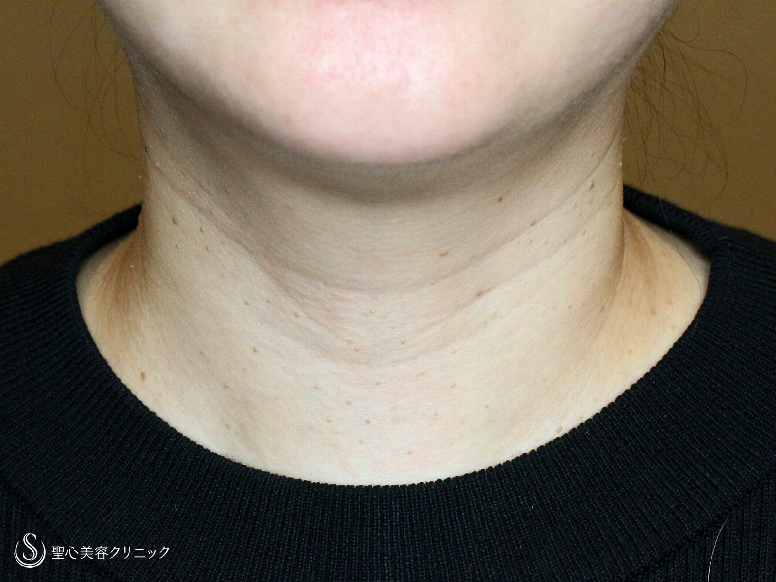 【40代女性・首の横ジワを綺麗にする】プレミアムPRP皮膚再生療法（9ヶ月後） Before 
