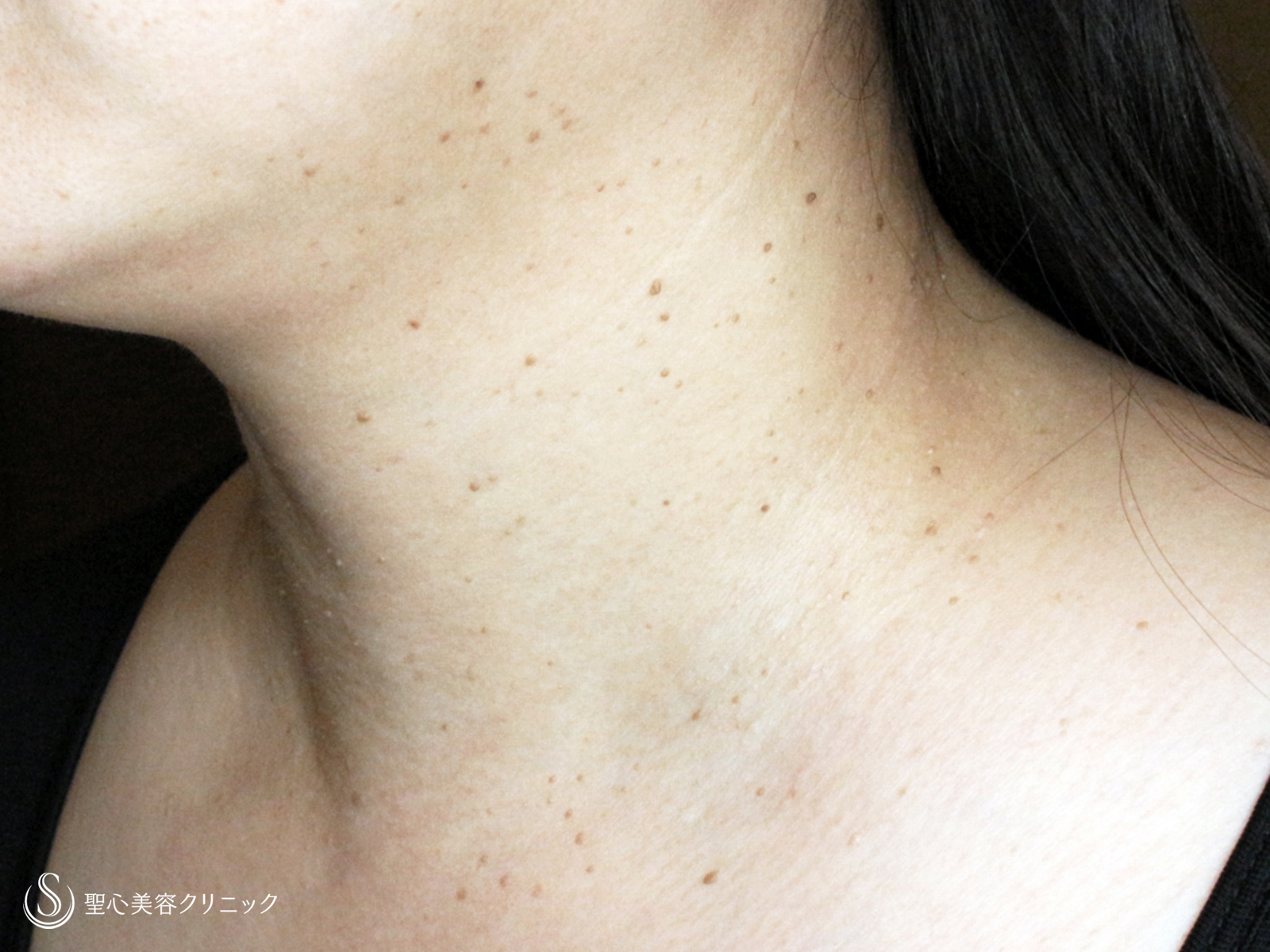 【40代女性・首の横ジワを綺麗にする】プレミアムPRP皮膚再生療法（9ヶ月後） After 