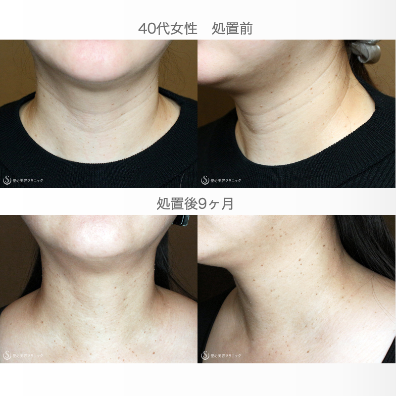 【40代女性・首の横ジワを綺麗にする】プレミアムPRP皮膚再生療法（9ヶ月後） After 