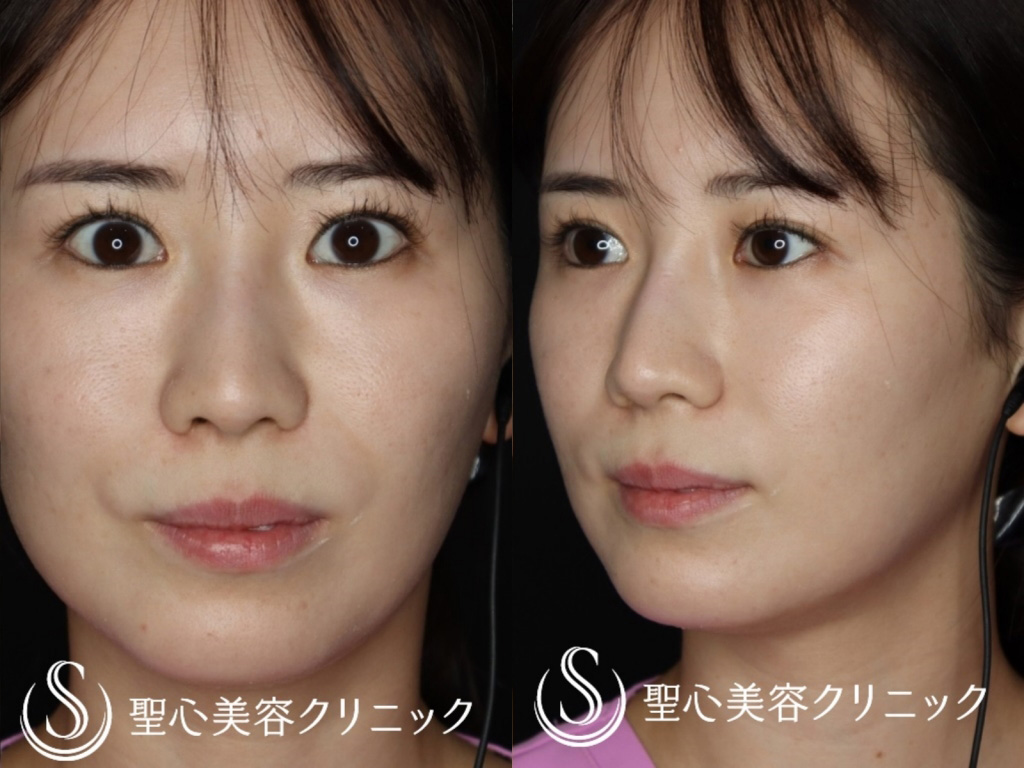 【30代女性・鼻筋を綺麗に】Gメッシュ（1ヶ月後） After 