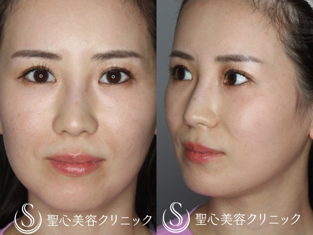 【30代女性・鼻筋を綺麗に】Gメッシュ（1ヶ月後） Before 
