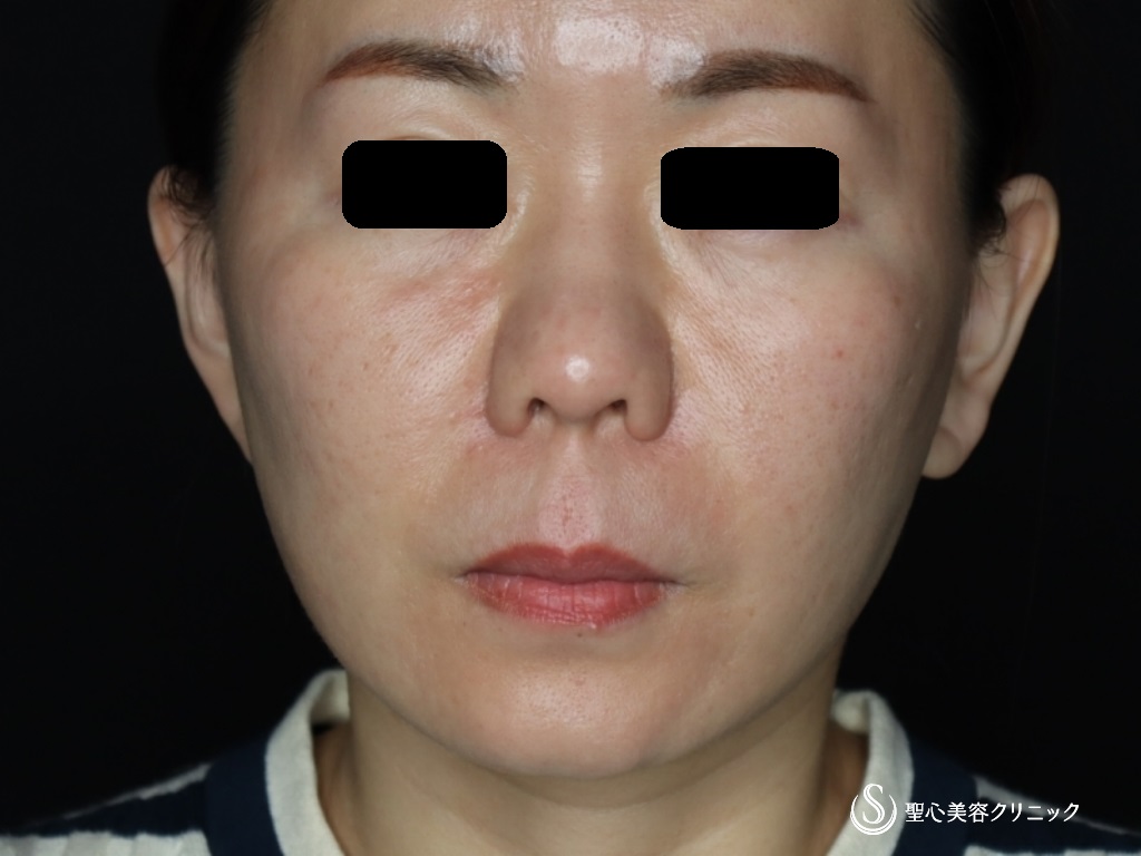 【40代女性・頬、フェイスラインのたるみ】フェイスリフト（頬あご下脂肪吸引）（3ヶ月後） After 