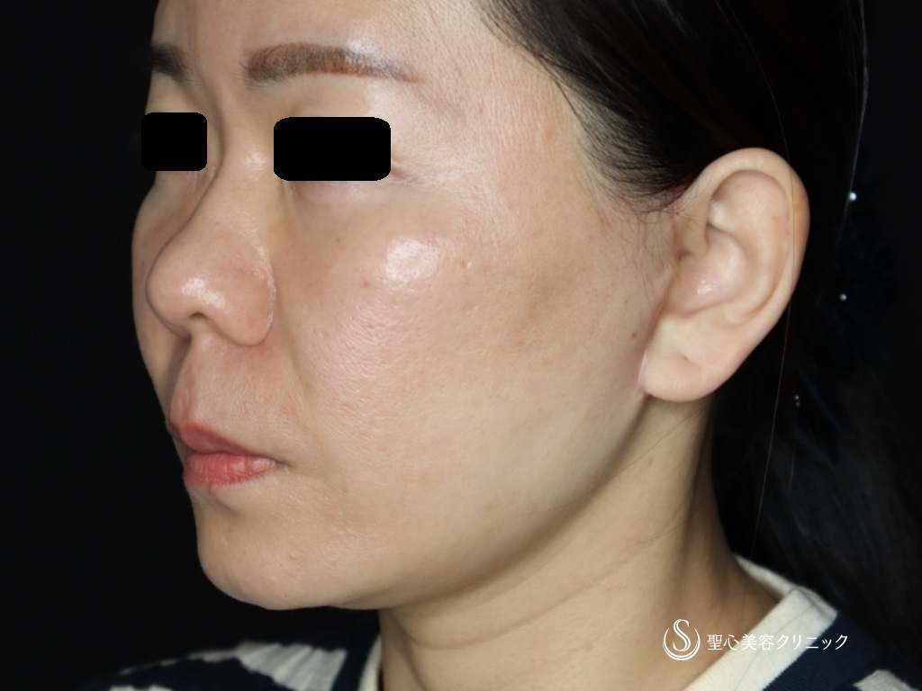 【40代女性・頬、フェイスラインのたるみ】フェイスリフト（頬あご下脂肪吸引）（3ヶ月後） After 
