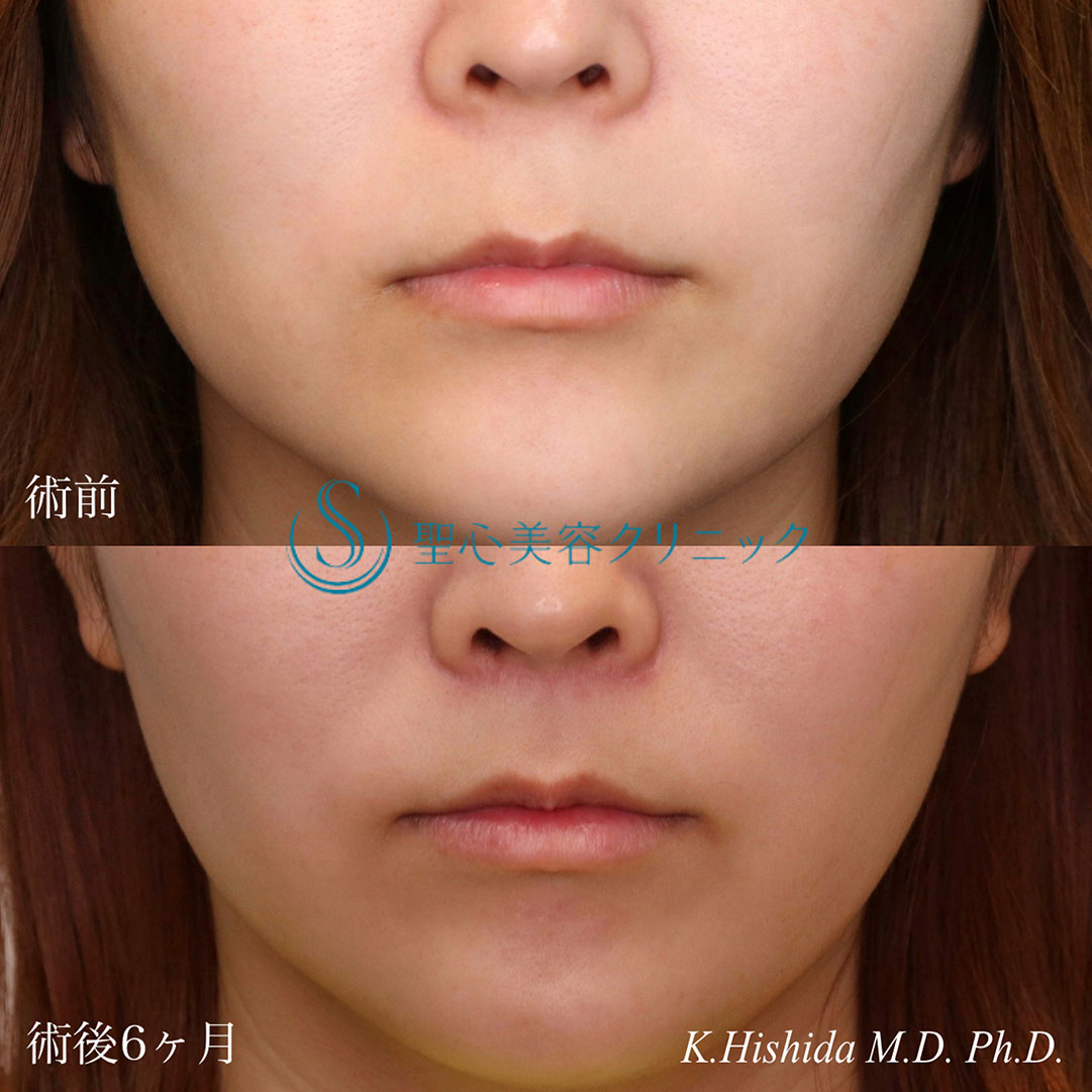 【30代女性・人中をバランスよく短くしたい！！】プレミアムリップリフト（プレミアム人中短縮術）（術後6ヶ月） After 