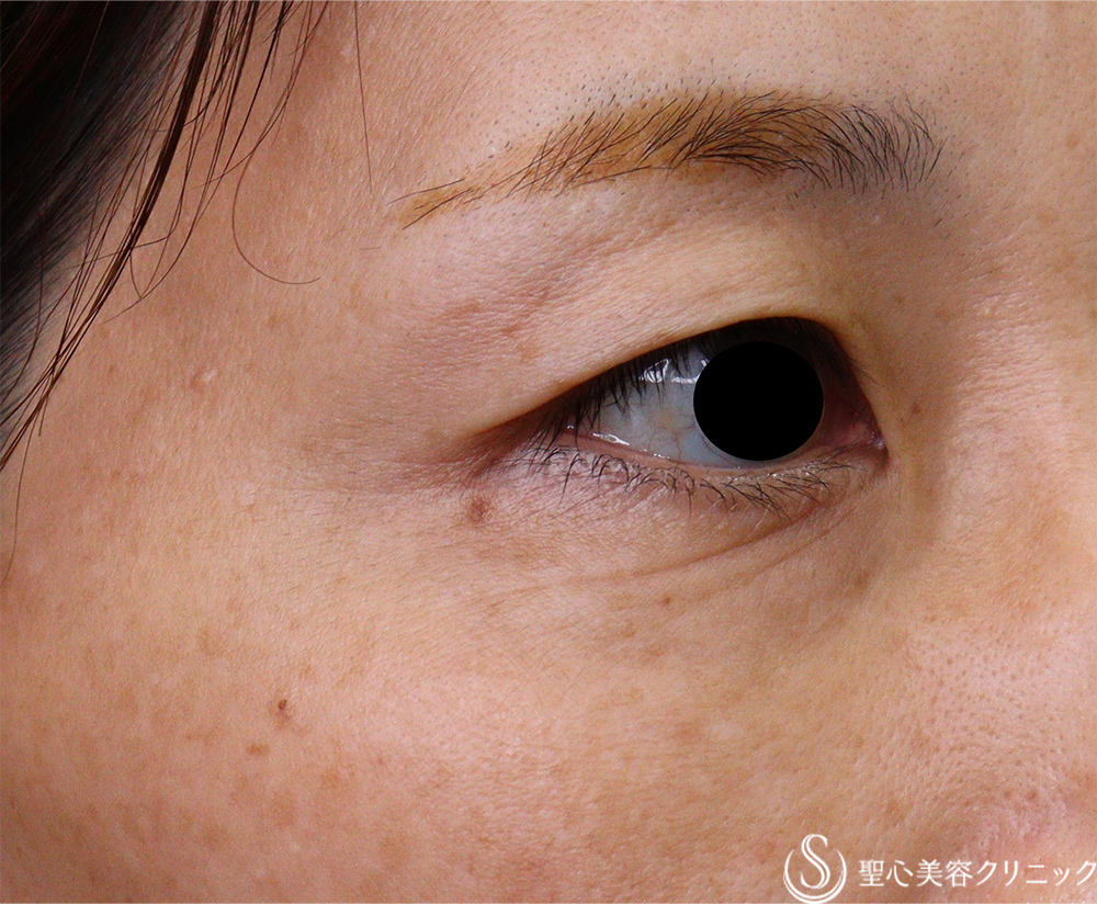 【40代女性・目の下のしわ】下眼瞼除皺術（術後2か月） Before 