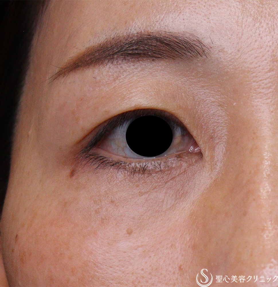 【40代女性・目の下のしわ】下眼瞼除皺術（術後2か月） After 